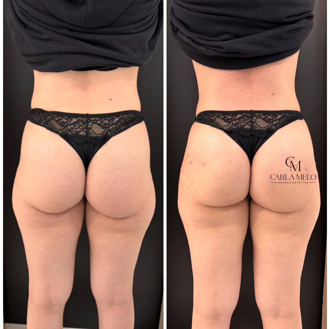 Resultado antes e depois 1