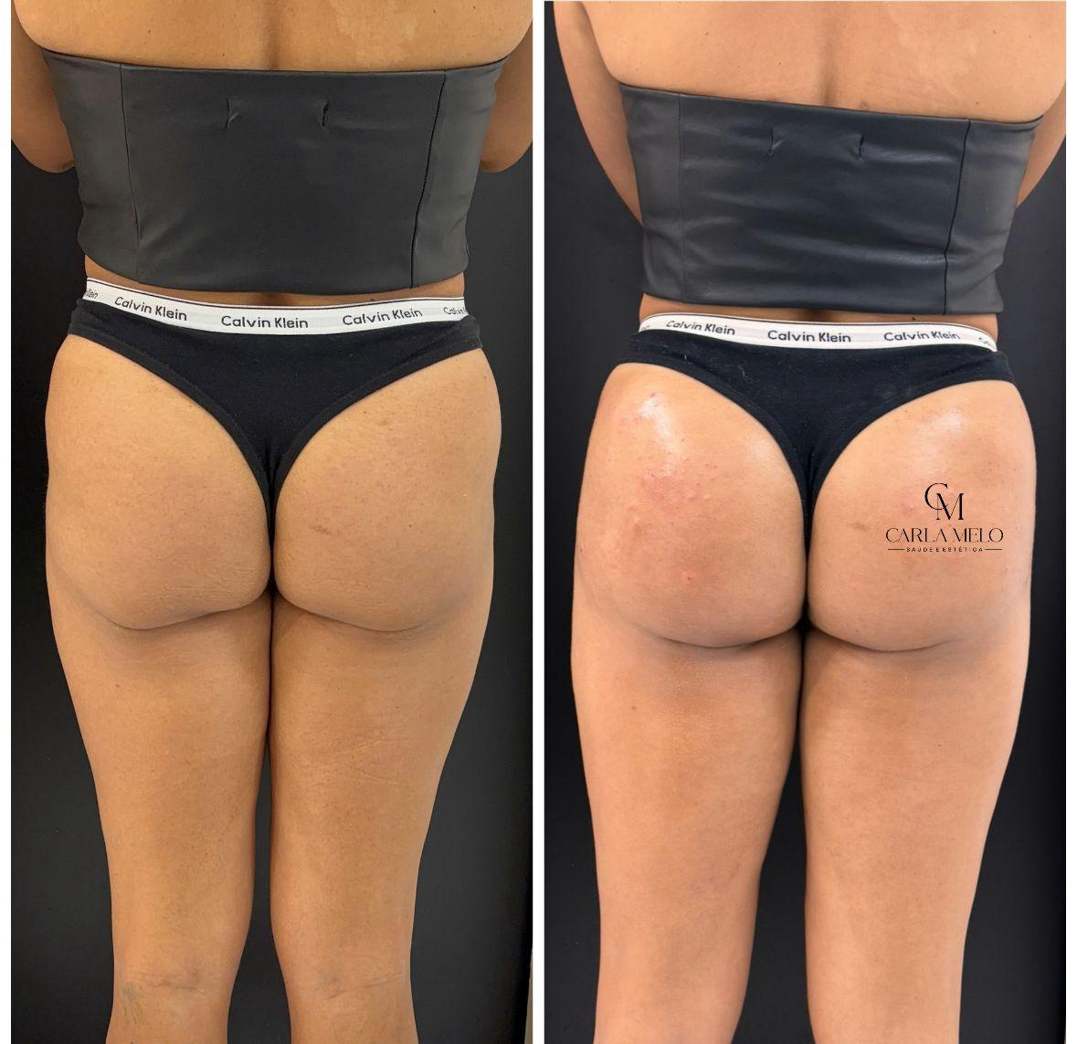 Resultado antes e depois 3